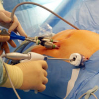 Laparoscopic gynaecological surgery