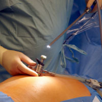 Laparoscopic gynaecological surgery